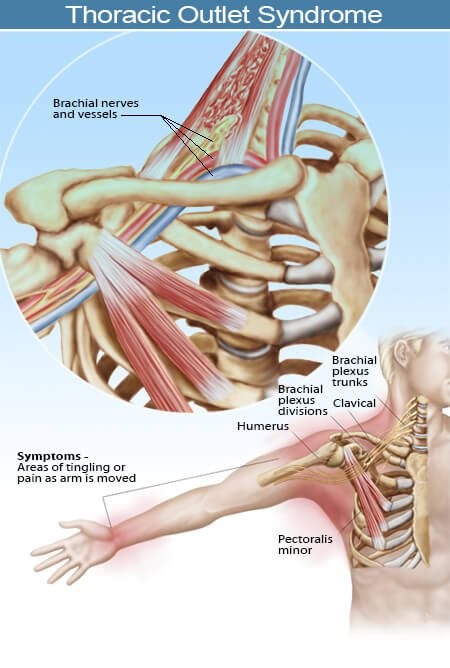 thoracic outlet syndrome sleeping position